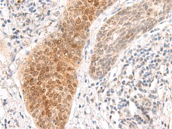 GHDC Antibody - Immunohistochemistry of paraffin-embedded Human esophagus cancer tissue  using GHDC Polyclonal Antibody at dilution of 1:90(×200)