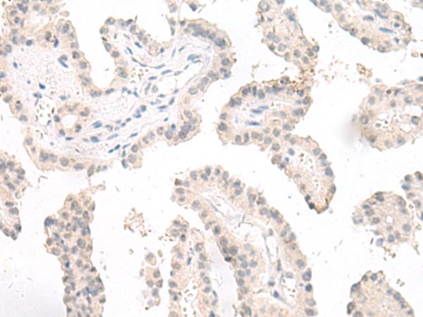 GHDC Antibody - Immunohistochemistry of paraffin-embedded Human thyroid cancer tissue  using GHDC Polyclonal Antibody at dilution of 1:90(×200)