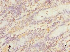GHITM Antibody - Immunohistochemistry of paraffin-embedded human gastric cancer using antibody at dilution of 1:100.