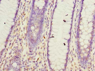 GHITM Antibody - Immunohistochemistry of paraffin-embedded human colon cancer using antibody at dilution of 1:100.