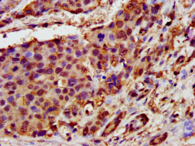 GHITM Antibody - IHC image of GHITM Antibody diluted at 1:400 and staining in paraffin-embedded human pancreatic cancer performed on a Leica BondTM system. After dewaxing and hydration, antigen retrieval was mediated by high pressure in a citrate buffer (pH 6.0). Section was blocked with 10% normal goat serum 30min at RT. Then primary antibody (1% BSA) was incubated at 4°C overnight. The primary is detected by a biotinylated secondary antibody and visualized using an HRP conjugated SP system.