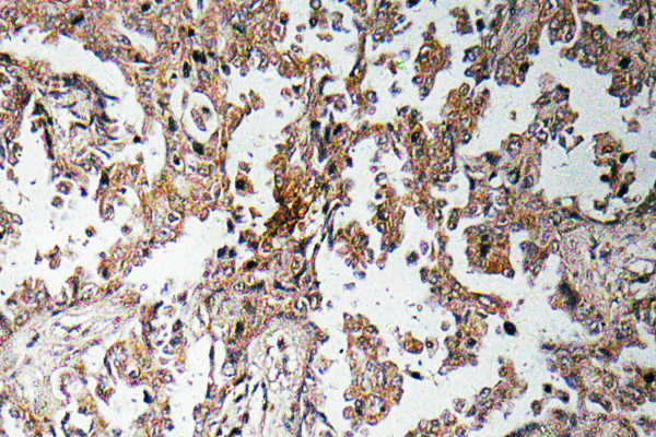 Ghrelin Antibody - Immunohistochemistry analysis of Ghrelin antibody in paraffin-embedded human lung carcinoma tissue.