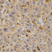 GHRH Antibody - Immunohistochemistry of paraffin-embedded human liver cancer tissue.