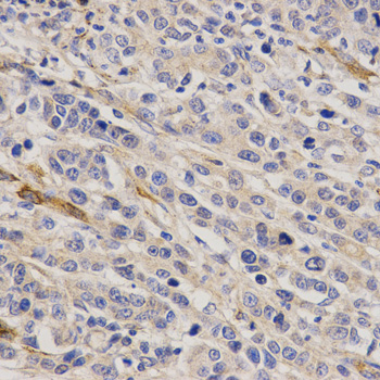 GHRH Antibody - Immunohistochemistry of paraffin-embedded human stomach cancer tissue.