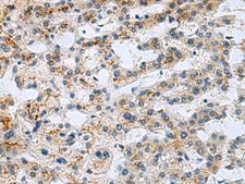 GHRHR Antibody - Immunohistochemistry of paraffin-embedded Human liver cancer tissue  using GHRHR Polyclonal Antibody at dilution of 1:40(×200)