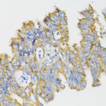 GHRL / Ghrelin Preproprotein Antibody - Immunohistochemistry of paraffin-embedded human rectal cancer using GHRL antibody at dilution of 1:100 (40x lens).