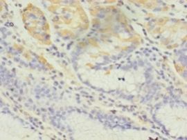 GIF / Intrinsic Factor Antibody - Immunohistochemistry of paraffin-embedded human gastric cancer using antibody at 1: 100 dilution.
