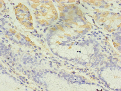 GIF / Intrinsic Factor Antibody - Immunohistochemistry of paraffin-embedded human gastric cancer using GIF Antibody at dilution of 1:100
