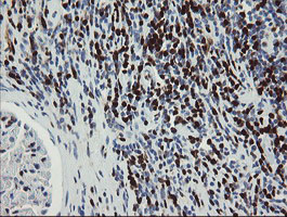 GIMAP4 Antibody - IHC of paraffin-embedded Carcinoma of Human kidney tissue using anti-GIMAP4 mouse monoclonal antibody.