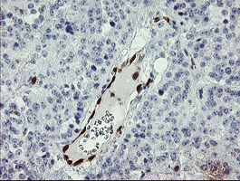 GIMAP4 Antibody - IHC of paraffin-embedded Carcinoma of Human pancreas tissue using anti-GIMAP4 mouse monoclonal antibody.