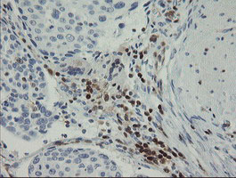 GIMAP4 Antibody - IHC of paraffin-embedded Carcinoma of Human bladder tissue using anti-GIMAP4 mouse monoclonal antibody.