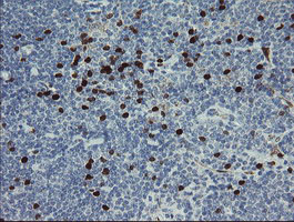 GIMAP4 Antibody - IHC of paraffin-embedded Human lymphoma tissue using anti-GIMAP4 mouse monoclonal antibody.