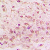 GIMAP4 Antibody - Immunohistochemical analysis of GIMAP4 staining in human lung cancer formalin fixed paraffin embedded tissue section. The section was pre-treated using heat mediated antigen retrieval with sodium citrate buffer (pH 6.0). The section was then incubated with the antibody at room temperature and detected using an HRP conjugated compact polymer system. DAB was used as the chromogen. The section was then counterstained with hematoxylin and mounted with DPX.