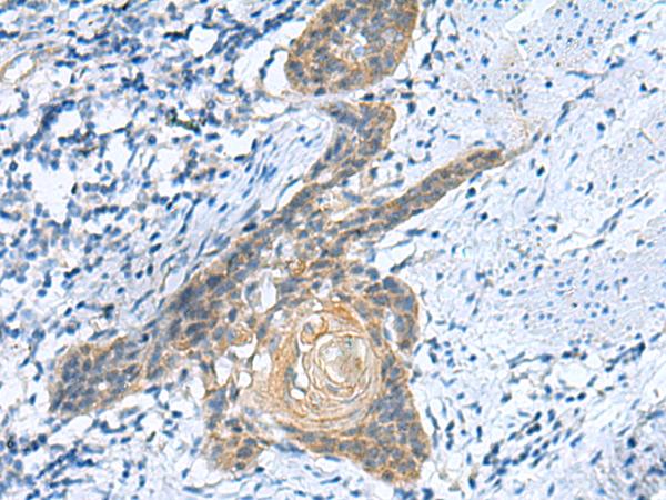 GINS3 Antibody - Immunohistochemistry of paraffin-embedded Human esophagus cancer tissue  using GINS3 Polyclonal Antibody at dilution of 1:50(×200)