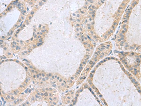 GINS3 Antibody - Immunohistochemistry of paraffin-embedded Human thyroid cancer tissue  using GINS3 Polyclonal Antibody at dilution of 1:50(×200)