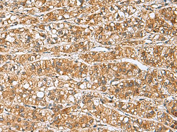 GINS3 Antibody - Immunohistochemistry of paraffin-embedded Human liver cancer tissue  using GINS3 Polyclonal Antibody at dilution of 1:60(×200)