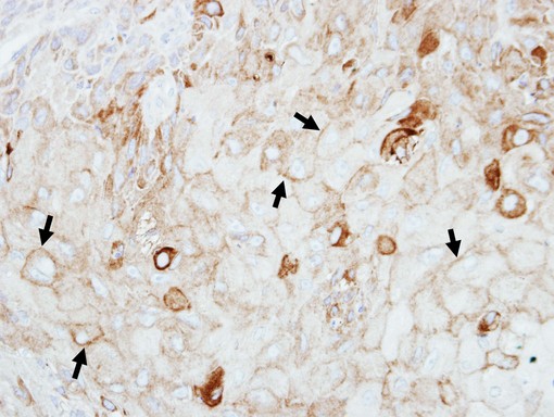 GIPC1 / GIPC Antibody - IHC of paraffin-embedded SCC4 xenograft using GIPC1 antibody at 1:100 dilution.