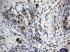 GIPC1 / GIPC Antibody - Immunohistochemical staining of paraffin-embedded Carcinoma of Human pancreas tissue using anti-GIPC1 mouse monoclonal antibody. (Heat-induced epitope retrieval by 1mM EDTA in 10mM Tris buffer. (pH8.5) at 120°C for 3 min. (1:500)