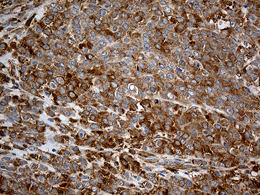 GIPC1 / GIPC Antibody - Immunohistochemical staining of paraffin-embedded Adenocarcinoma of Human breast tissue tissue using anti-GIPC1 mouse monoclonal antibody. (Heat-induced epitope retrieval by 1mM EDTA in 10mM Tris buffer. (pH8.5) at 120°C for 3 min. (1:500)