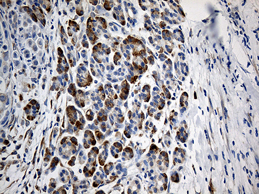 GIPC1 / GIPC Antibody - Immunohistochemical staining of paraffin-embedded Carcinoma of Human pancreas tissue using anti-GIPC1 mouse monoclonal antibody. (Heat-induced epitope retrieval by 1mM EDTA in 10mM Tris buffer. (pH8.5) at 120°C for 3 min. (1:500)