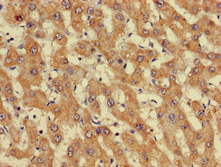 GIPC1 / GIPC Antibody - Immunohistochemistry of paraffin-embedded human liver cancer at dilution of 1:100
