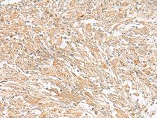 GIPC1 / GIPC Antibody - Immunohistochemistry of paraffin-embedded Human liver cancer tissue  using GIPC1 Polyclonal Antibody at dilution of 1:50(×200)