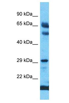 GIPC2 Antibody - GIPC2 antibody Western Blot of Esophagus Tumor. Antibody dilution: 1 ug/ml.  This image was taken for the unconjugated form of this product. Other forms have not been tested.