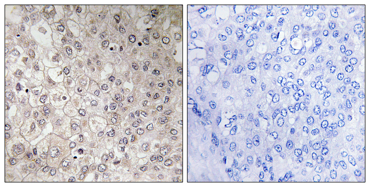 GIPR / GIP Receptor Antibody - Immunohistochemistry analysis of paraffin-embedded human liver carcinoma tissue, using GIPR Antibody. The picture on the right is blocked with the synthesized peptide.