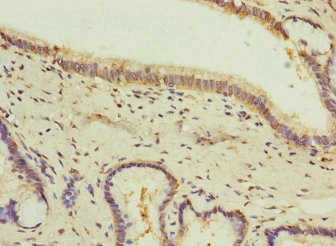 GIPR / GIP Receptor Antibody - Immunohistochemistry of paraffin-embedded human prostata cancer at dilution 1:100