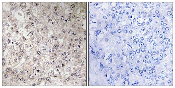 GIPR / GIP Receptor Antibody - Peptide - + Immunohistochemistry analysis of paraffin-embedded human liver carcinoma tissue using GIPR antibody.
