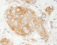 GIT1 Antibody - Detection of Human GIT1 by Immunohistochemistry. Sample: FFPE section of human breast carcinoma. Antibody: Affinity purified rabbit anti-GIT1 used at a dilution of 1:200 (1 Detection: DAB.