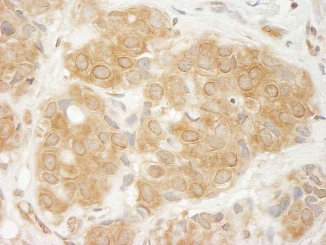 GIT1 Antibody - Detection of Human GIT1 by Immunohistochemistry. Sample: FFPE section of human breast carcinoma. Antibody: Affinity purified rabbit anti-GIT1 used at a dilution of 1:1000 (1 Detection: DAB.