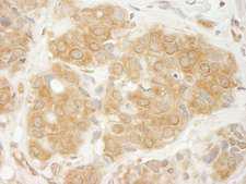 GIT1 Antibody - Detection of Human GIT1 by Immunohistochemistry. Sample: FFPE section of human breast carcinoma. Antibody: Affinity purified rabbit anti-GIT1 used at a dilution of 1:1000 (1 Detection: DAB.