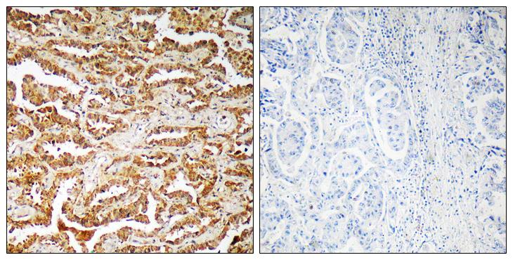GIT1 Antibody - Peptide - + Immunohistochemistry analysis of paraffin-embedded human lung carcinoma tissue, using GIT1 antibody.