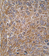 GIT1 Antibody - Formalin-fixed and paraffin-embedded human lung carcinoma tissue reacted with GIT1 Antibody (Y510) , which was peroxidase-conjugated to the secondary antibody, followed by DAB staining. This data demonstrates the use of this antibody for immunohistochemistry; clinical relevance has not been evaluated.