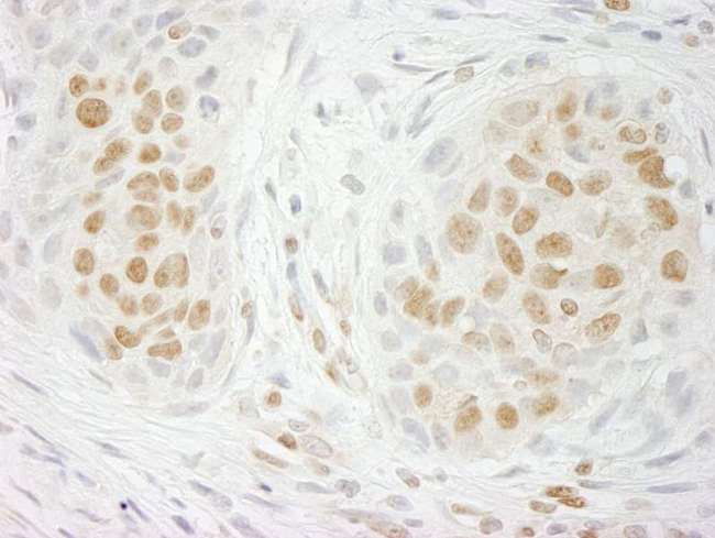GIT2 Antibody - Detection of Human GIT2 Immunohistochemistry. Sample: FFPE section of human lung carcinoma. Antibody: Affinity purified rabbit anti-GIT2 used at a dilution of 1:500.