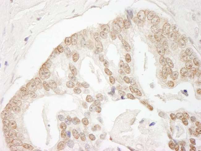 GIT2 Antibody - Detection of Human GIT2 by Immunohistochemistry. Sample: FFPE section of human prostate carcinoma. Antibody: Affinity purified rabbit anti-GIT2 used at a dilution of 1:1000 (1 Detection: DAB.