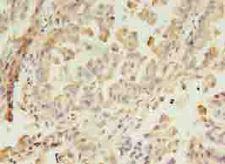GIT2 Antibody - Immunohistochemistry of paraffin-embedded human lung cancer using antibody at dilution of 1:100.