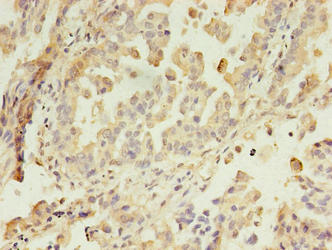 GIT2 Antibody - Immunohistochemistry of paraffin-embedded human lung cancer using GIT2 Antibody at dilution of 1:100