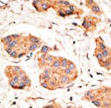 GJA1 / CX43 / Connexin 43 Antibody - Formalin-fixed and paraffin-embedded human cancer tissue reacted with the primary antibody, which was peroxidase-conjugated to the secondary antibody, followed by DAB staining. This data demonstrates the use of this antibody for immunohistochemistry; clinical relevance has not been evaluated. BC = breast carcinoma; HC = hepatocarcinoma.