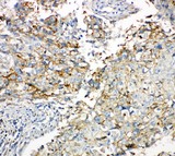 GJA1 / CX43 / Connexin 43 Antibody - Connexin 43/GJA1 antibody IHC-paraffin: Human Lung Cancer Tissue.