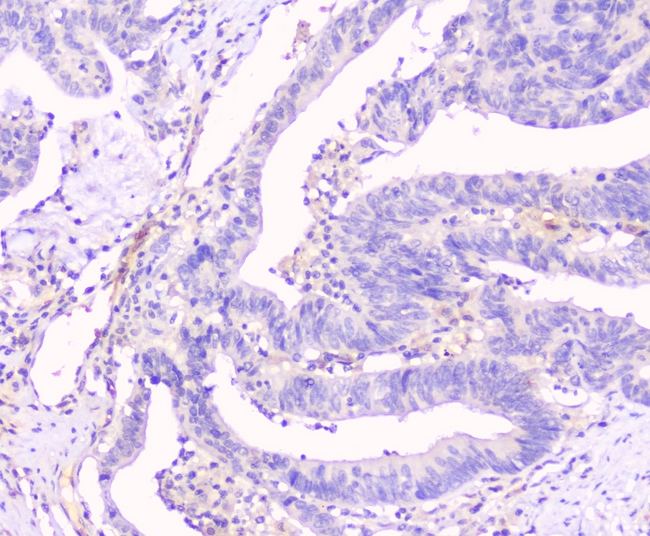 GJA1 / CX43 / Connexin 43 Antibody - IHC analysis of Connexin 43/GJA1 using anti-Connexin 43/GJA1 antibody. Connexin 43/GJA1 was detected in paraffin-embedded section of human intestinal cancer tissues. Heat mediated antigen retrieval was performed in citrate buffer (pH6, epitope retrieval solution) for 20 mins. The tissue section was blocked with 10% goat serum. The tissue section was then incubated with 1µg/ml rabbit anti-Connexin 43/GJA1 Antibody overnight at 4°C. Biotinylated goat anti-rabbit IgG was used as secondary antibody and incubated for 30 minutes at 37°C. The tissue section was developed using Strepavidin-Biotin-Complex (SABC) with DAB as the chromogen.