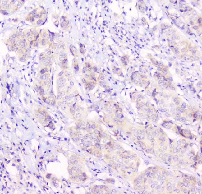 GJA1 / CX43 / Connexin 43 Antibody - IHC analysis of Connexin 43/GJA1 using anti-Connexin 43/GJA1 antibody. Connexin 43/GJA1 was detected in paraffin-embedded section of human mammary cancer tissues. Heat mediated antigen retrieval was performed in citrate buffer (pH6, epitope retrieval solution) for 20 mins. The tissue section was blocked with 10% goat serum. The tissue section was then incubated with 1µg/ml rabbit anti-Connexin 43/GJA1 Antibody overnight at 4°C. Biotinylated goat anti-rabbit IgG was used as secondary antibody and incubated for 30 minutes at 37°C. The tissue section was developed using Strepavidin-Biotin-Complex (SABC) with DAB as the chromogen.