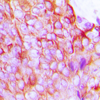 GJA1 / CX43 / Connexin 43 Antibody - Immunohistochemical analysis of Connexin 43 (pS368) staining in human breast cancer formalin fixed paraffin embedded tissue section. The section was pre-treated using heat mediated antigen retrieval with sodium citrate buffer (pH 6.0). The section was then incubated with the antibody at room temperature and detected using an HRP conjugated compact polymer system. DAB was used as the chromogen. The section was then counterstained with hematoxylin and mounted with DPX.