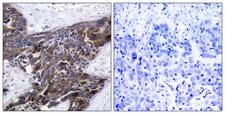 GJA1 / CX43 / Connexin 43 Antibody - Immunohistochemistry analysis of paraffin-embedded human breast carcinoma, using Connexin 43 (Phospho-Ser367) Antibody. The picture on the right is blocked with the phospho peptide.