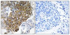 GJA3 / CX46 / Connexin 46 Antibody - Immunohistochemistry analysis of paraffin-embedded human lung carcinoma tissue, using GJA3 Antibody. The picture on the right is blocked with the synthesized peptide.