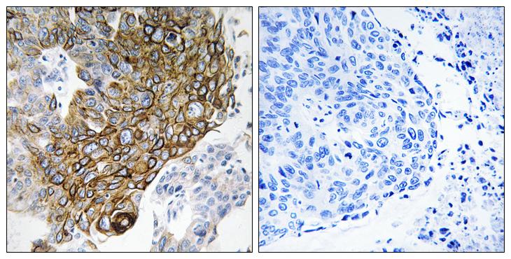 GJA3 / CX46 / Connexin 46 Antibody - Peptide - + Immunohistochemistry analysis of paraffin-embedded human lung carcinoma tissue using GJA3 antibody.