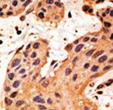 GJA8 / CX50 / Connexin 50 Antibody - Formalin-fixed and paraffin-embedded human cancer tissue reacted with the primary antibody, which was peroxidase-conjugated to the secondary antibody, followed by DAB staining. This data demonstrates the use of this antibody for immunohistochemistry; clinical relevance has not been evaluated. BC = breast carcinoma; HC = hepatocarcinoma.