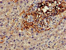 GJA8 / CX50 / Connexin 50 Antibody - Immunohistochemistry of paraffin-embedded human liver cancer using GJA8 Antibody at dilution of 1:100