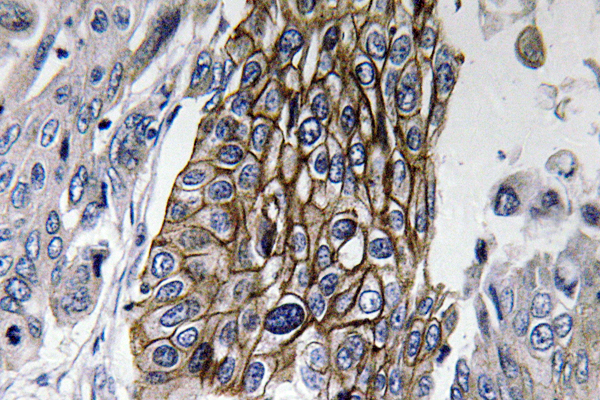 GJB1 / CX32 / Connexin 32 Antibody - IHC of Connexin-32 (L115) pAb in paraffin-embedded human lung carcinoma tissue.